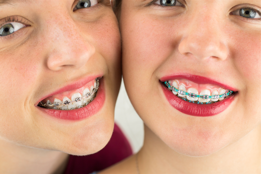 Apparecchi ortodontici1