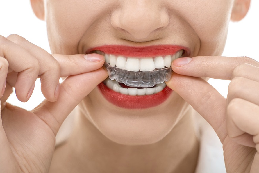 Apparecchi ortodontici2