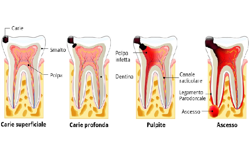 Carie radicolare2