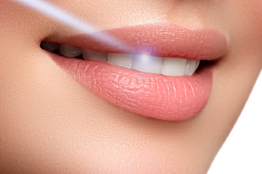 Laser in odontoiatria2